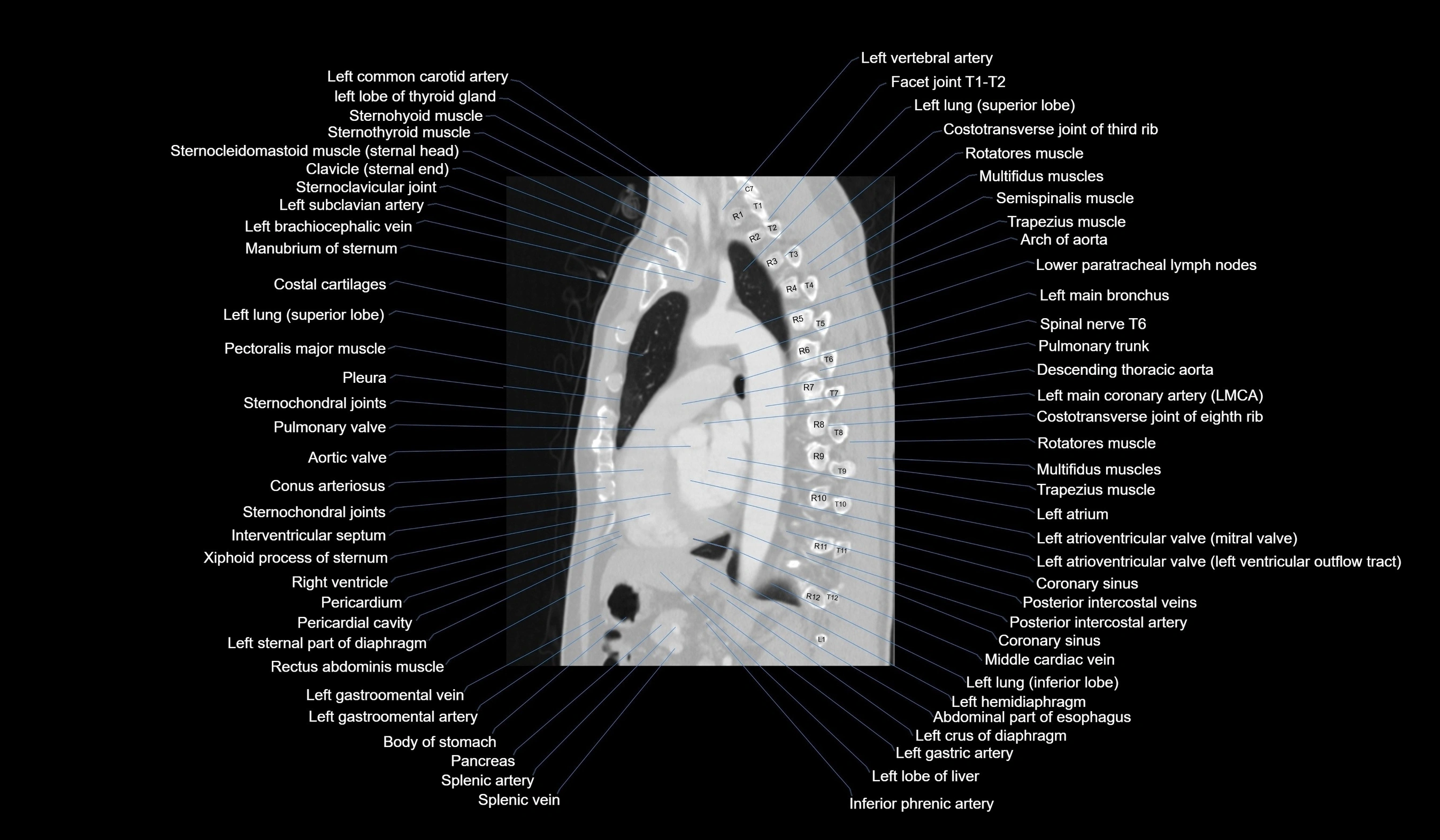 CT chest (thorax) labelled sagittal cross sectional anatomy radiology image-00082.webp